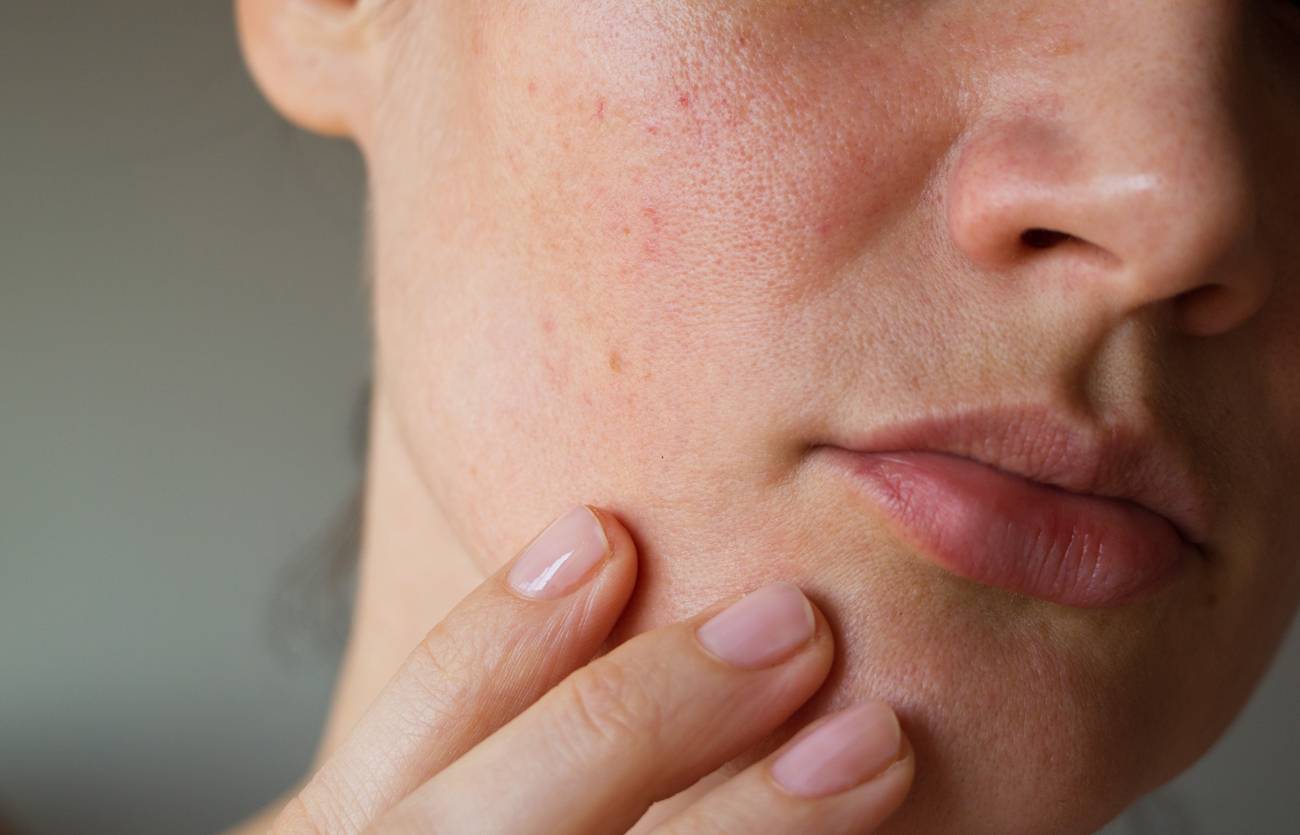 Irritation de la peau : comment la stopper ?