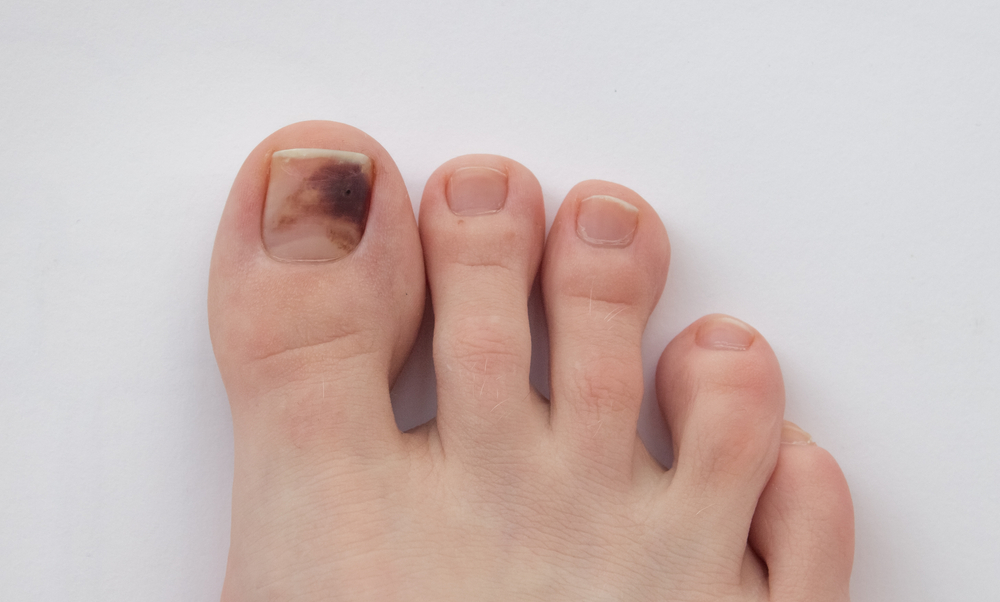 toe-nail-melanoma-pictures-photos