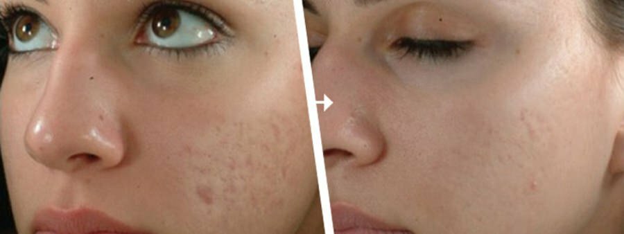 Microneedling pour acné