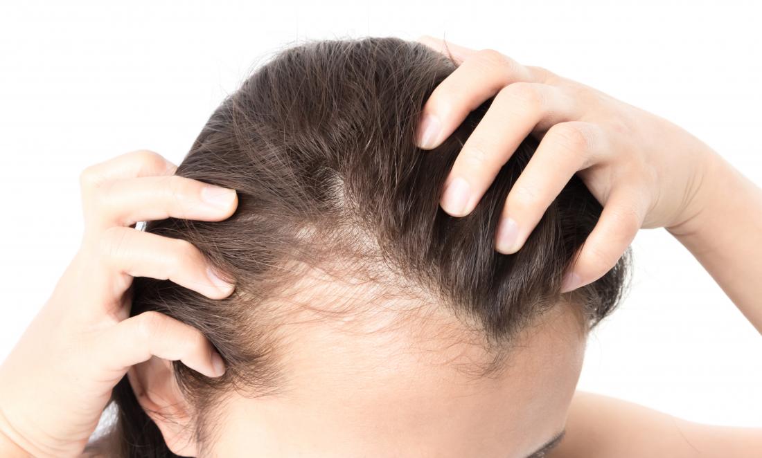 Alopécie : les solutions naturelles pour ne plus perdre ses cheveux