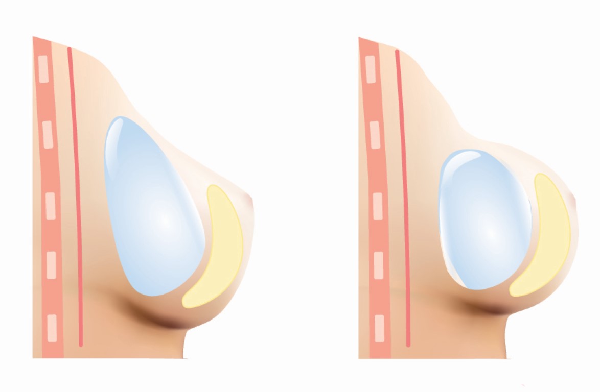 implants seins forme poire ou rond