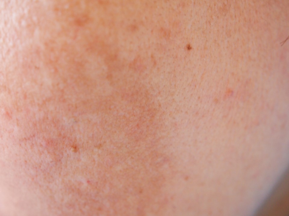 pourquoi taches pigmentaires apparaissent-elles