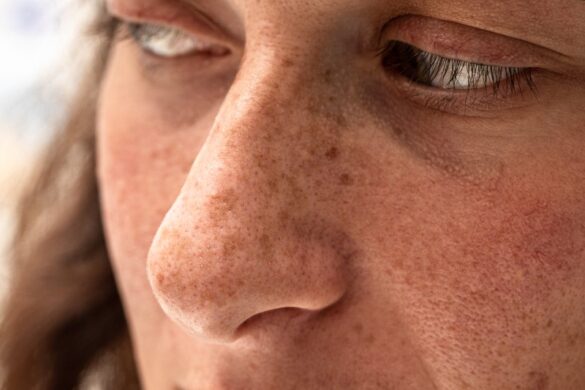 Hyperpigmentation post-été : comment réparer sans décaper sa peau