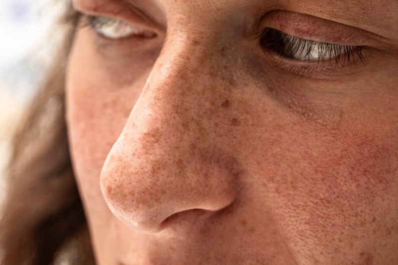 Hyperpigmentation post-été : comment réparer sans décaper sa peau